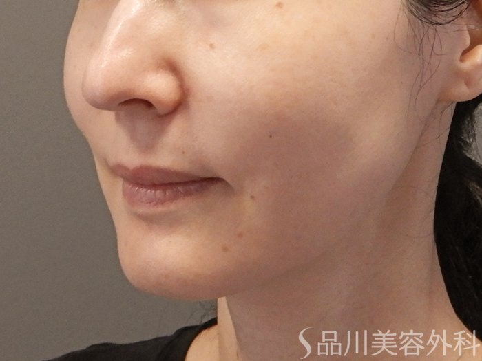 症例NO.71404のBEFORE写真