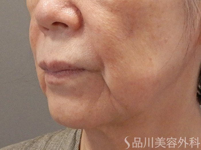 症例NO.71712のBEFORE写真