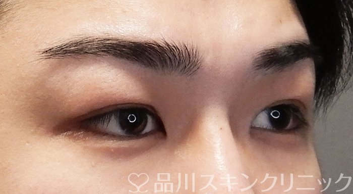 症例NO.69613のBEFORE写真