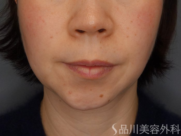 症例NO.69339のBEFORE写真