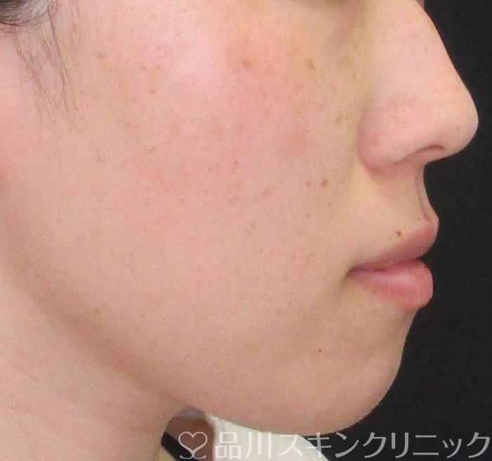 症例NO.72680のAFTER写真