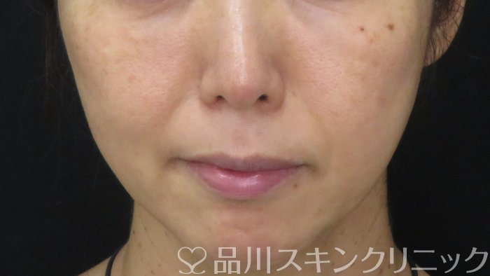 症例NO.71023のAFTER写真
