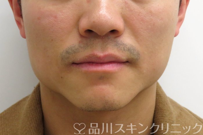 症例NO.72938のAFTER写真