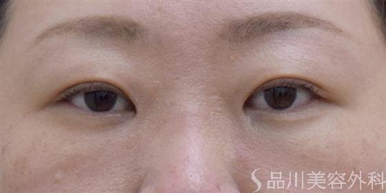 症例NO.61016のAFTER写真