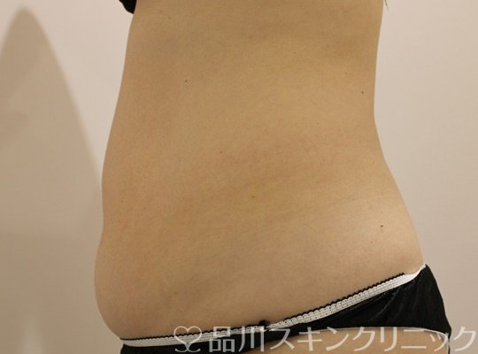 症例NO.69595のBEFORE写真