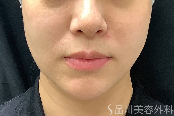 症例NO.73313のAFTER写真