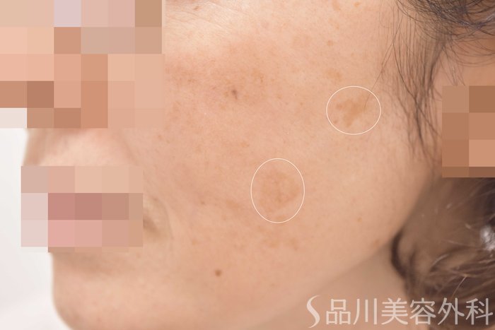 症例NO.64711のBEFORE写真