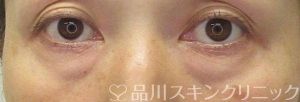 症例NO.71305のBEFORE写真