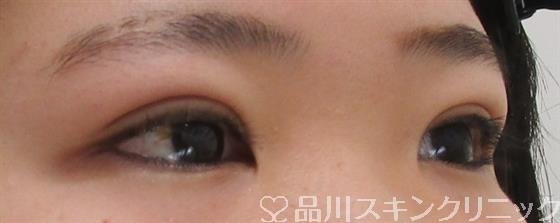 症例NO.41630のAFTER写真