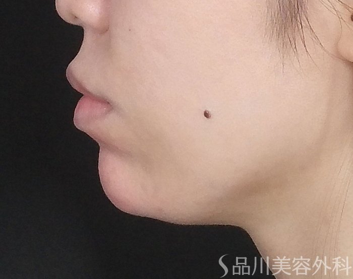 症例NO.65453のAFTER写真