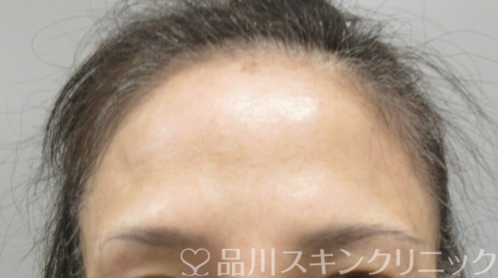 症例NO.74418のBEFORE写真