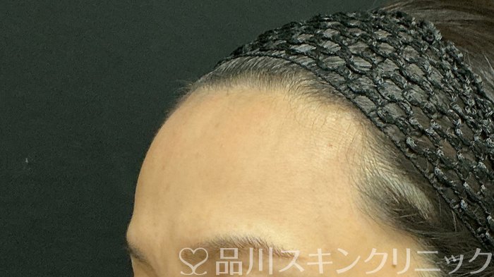 症例NO.74663のBEFORE写真