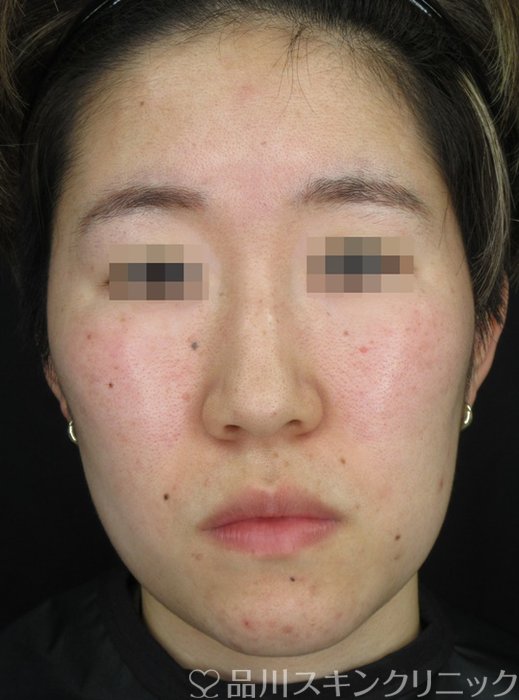 症例NO.72055のBEFORE写真