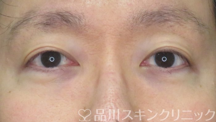 症例NO.70390のBEFORE写真