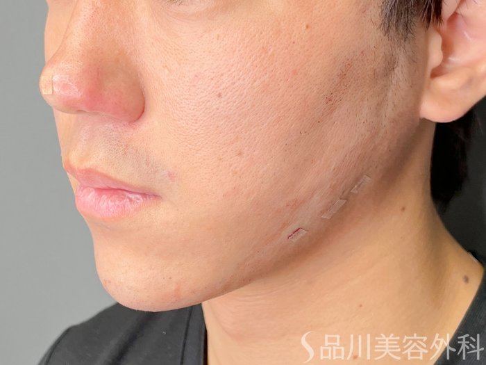 症例NO.73657のAFTER写真
