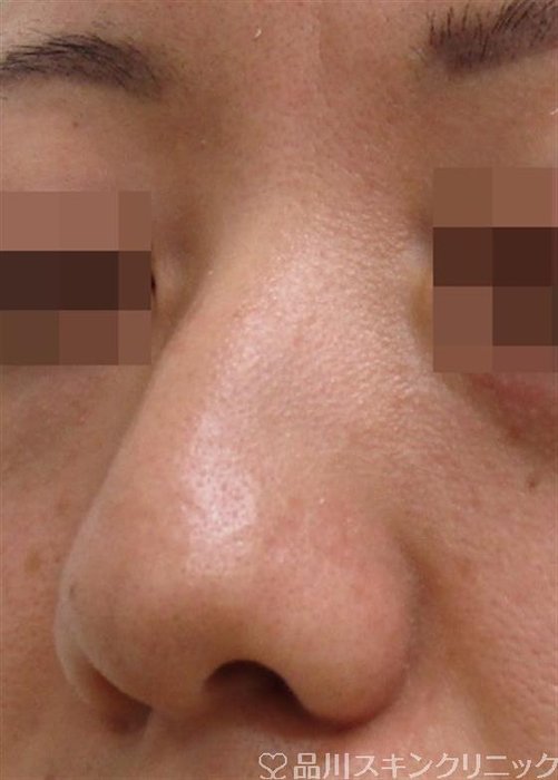 症例NO.37025のBEFORE写真