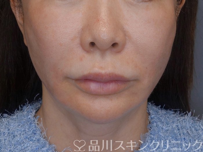 症例NO.73994のAFTER写真