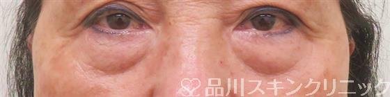 症例NO.58386のBEFORE写真