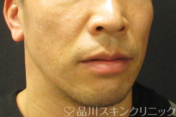 症例NO.68443のBEFORE写真
