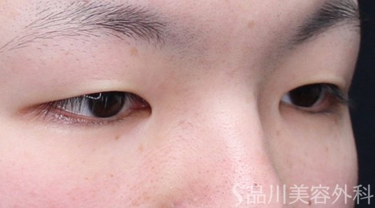 症例NO.73559のBEFORE写真