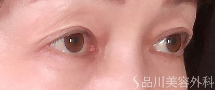 症例NO.69940のAFTER写真