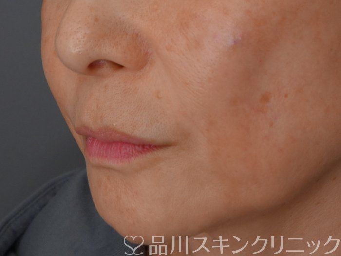 症例NO.72580のAFTER写真