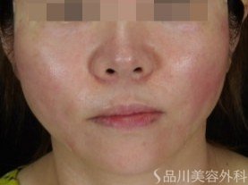 症例NO.71480のAFTER写真