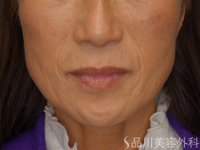 症例NO.69773のBEFORE写真