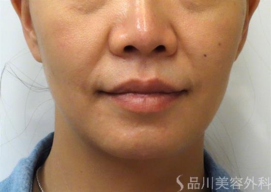 症例NO.35623のBEFORE写真