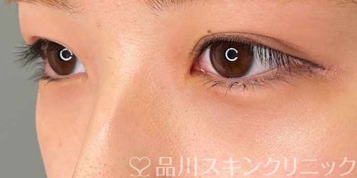 症例NO.69726のAFTER写真