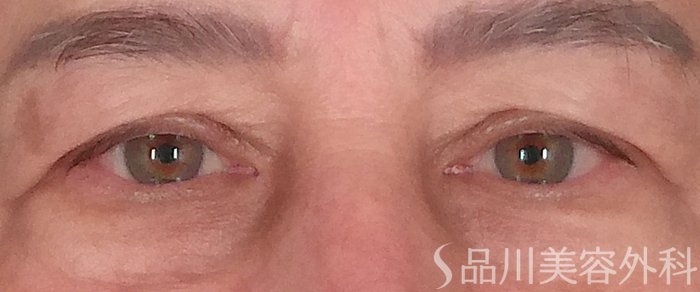 症例NO.70441のBEFORE写真