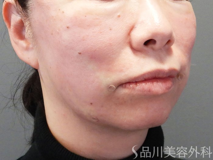 症例NO.73373のAFTER写真