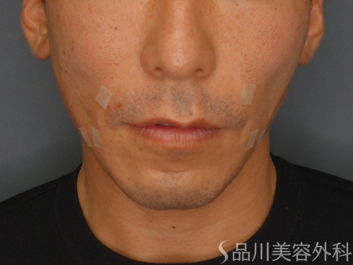 症例NO.65001のAFTER写真
