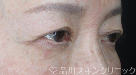 症例NO.69533のBEFORE写真