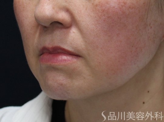症例NO.74743のBEFORE写真