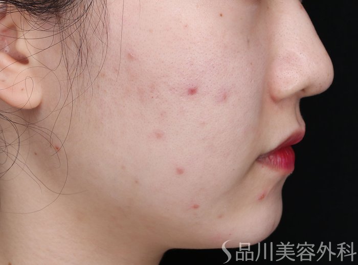 症例NO.69403のBEFORE写真