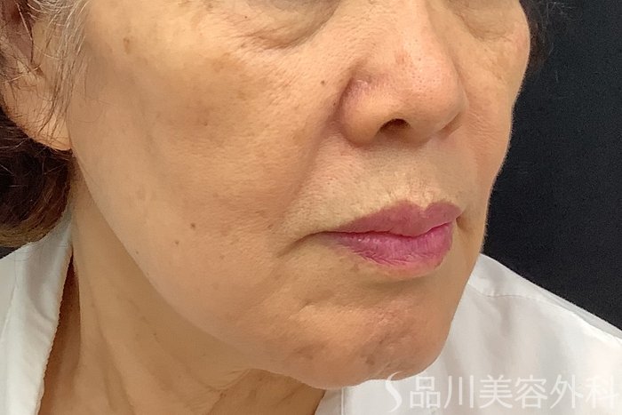 症例NO.71242のBEFORE写真