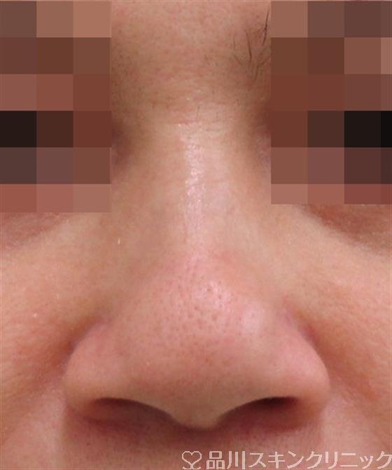 症例NO.33428のBEFORE写真