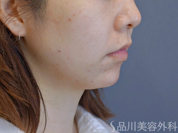 症例NO.74004のAFTER写真