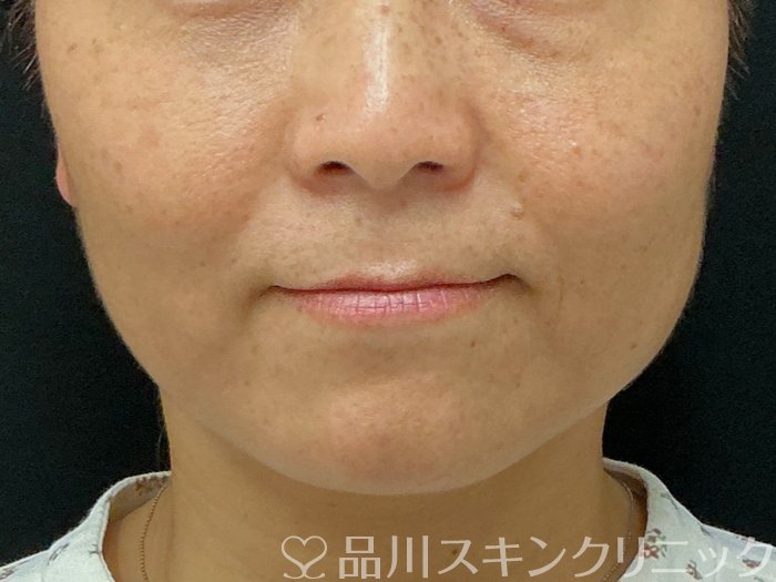 症例NO.74527のBEFORE写真