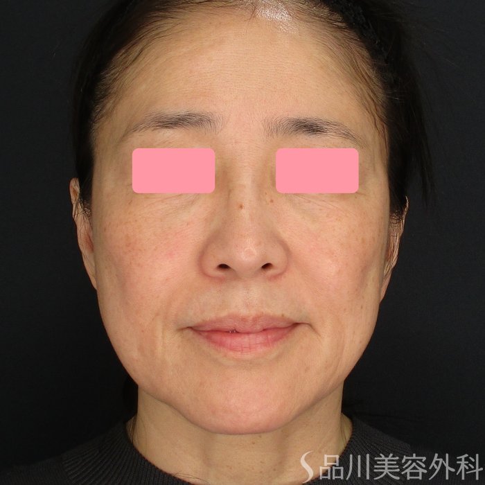 症例NO.75319のBEFORE写真
