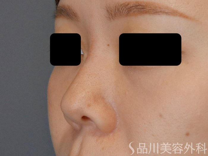 症例NO.70400のAFTER写真
