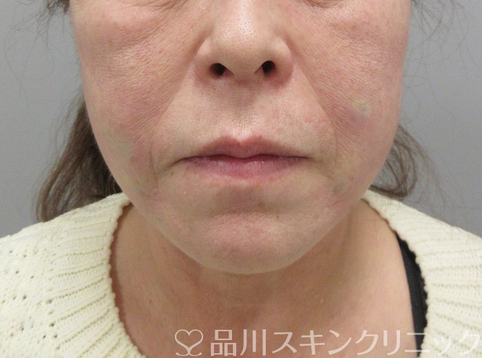 症例NO.69824のAFTER写真