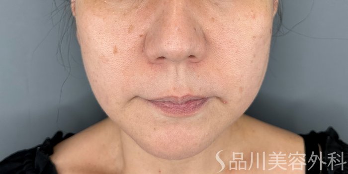 症例NO.74619のBEFORE写真