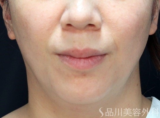 症例NO.62000のAFTER写真