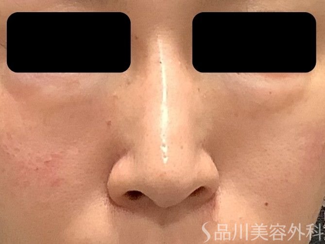 症例NO.75322のAFTER写真