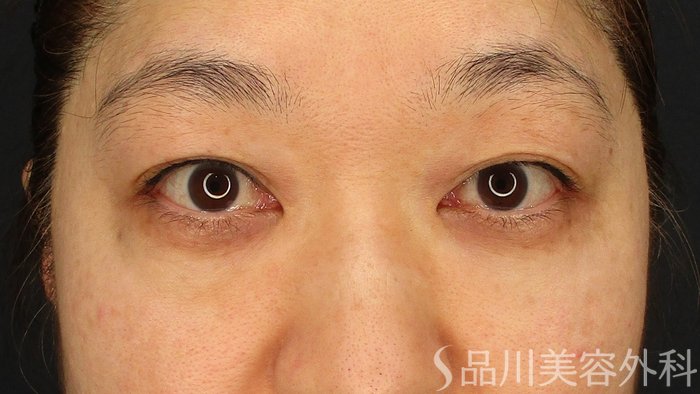 症例NO.63536のBEFORE写真