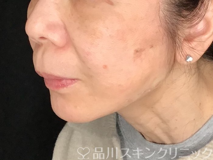 症例NO.64991のAFTER写真