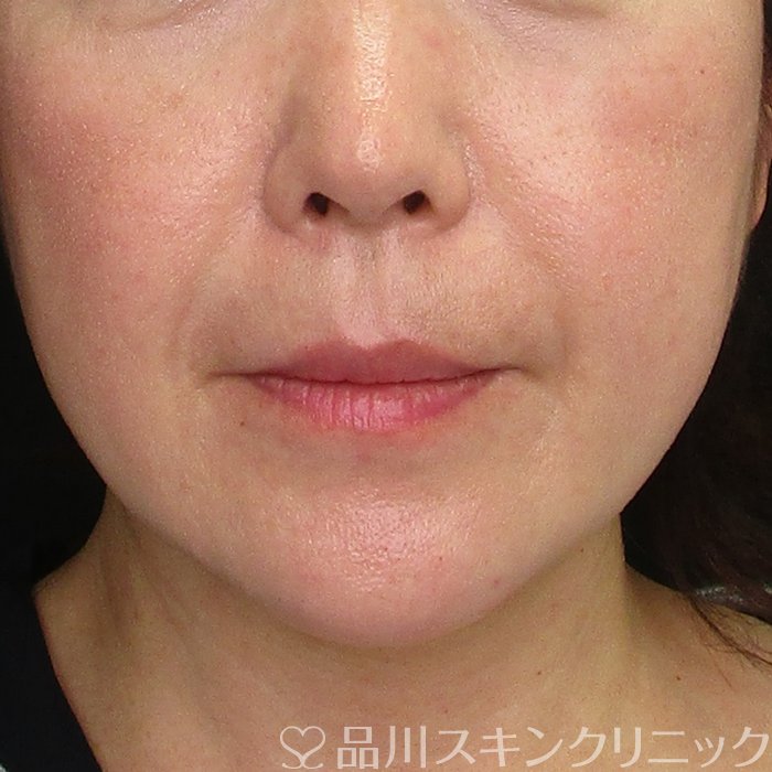 症例NO.70087のBEFORE写真