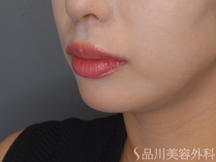 症例NO.66801のBEFORE写真